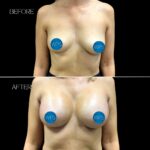 Breast Augmentation Surgery Before & After by Dr. Morgan at Wilmington Plastic Surgery