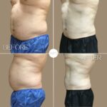 Coolsculpting Procedure Before & After by Wilmington Plastic Surgery