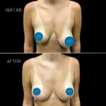 Breast Reduction Surgery Before & After by Dr. Morgan at Wilmington Plastic Surgery