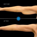 Arm Lift Procedure Before & After by Dr. White at Wilmington Plastic Surgery