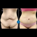 Tummy Tuck Procedure Before & After by Dr. White at Wilmington Plastic Surgery