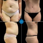 Tummy Tuck Procedure Before & After by Dr. White at Wilmington Plastic Surgery