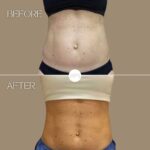 Coolsculpting Procedure Before & After by Wilmington Plastic Surgery