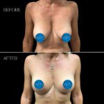 Breast Lift by Dr. Morgan at Wilmington Plastic Surgery