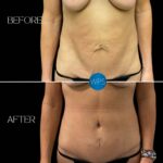 Tummy Tuck by Dr. Morgan at Wilmington Plastic Surgery Before & After Results